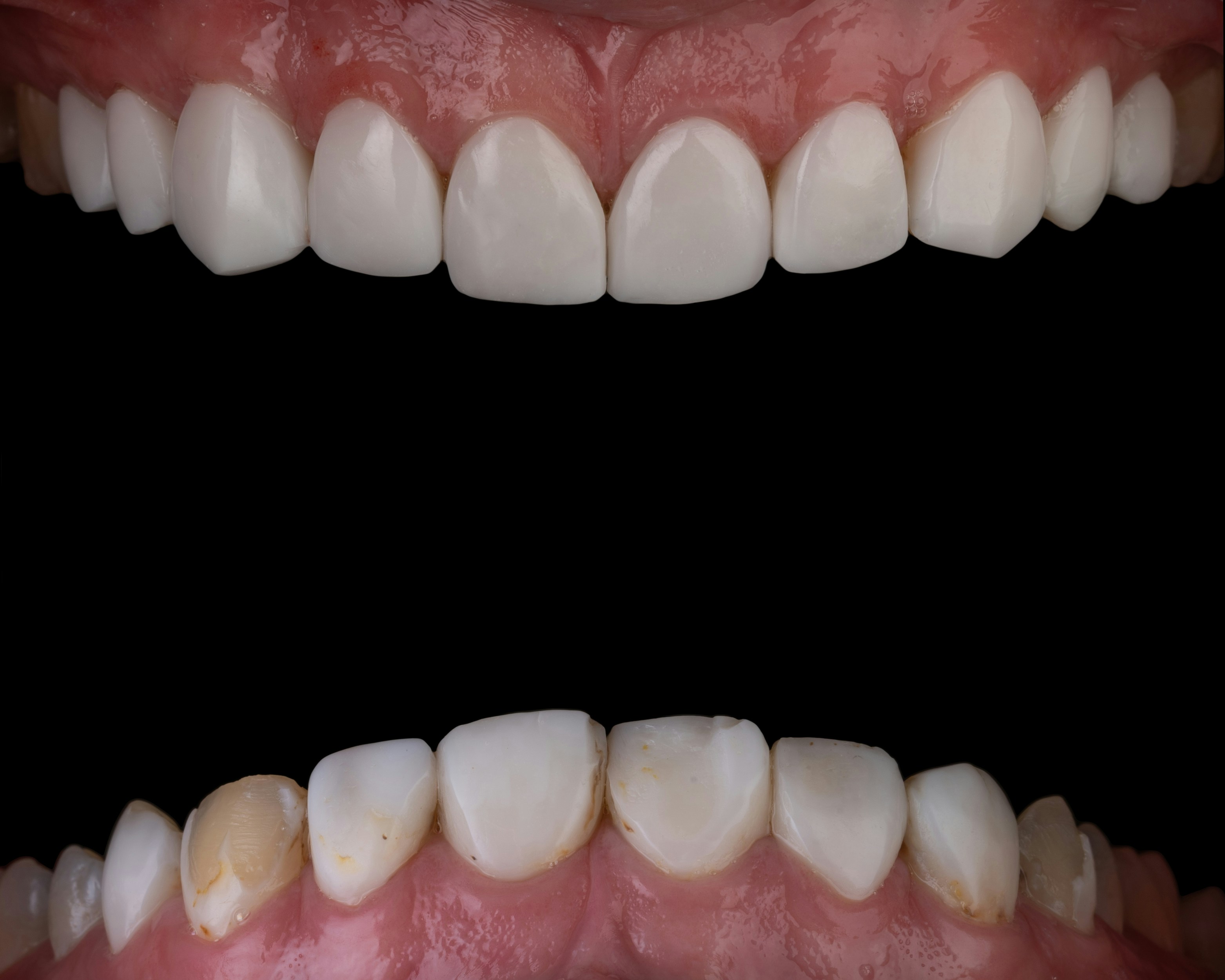 Rezultat implant dentar